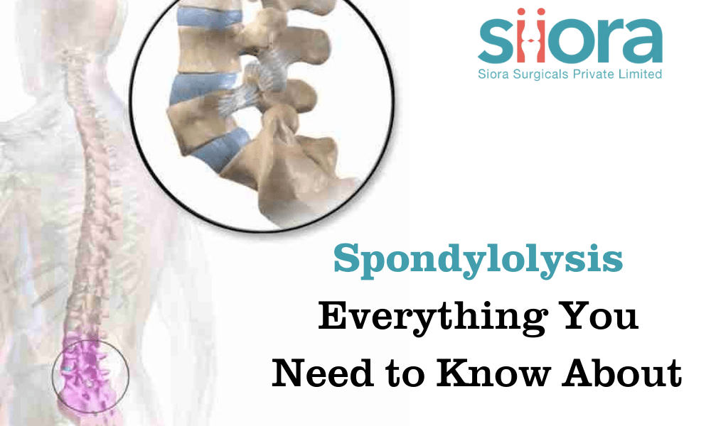 Spondylolysis – Everything You Need to Know About 